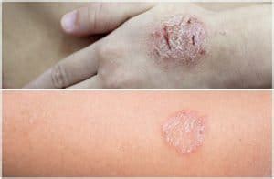 Nummular Eczema vs Ringworm - Symptoms, Causes, Diagnosis, Treatment ...