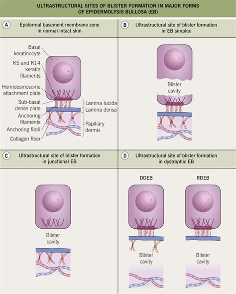 Epidermolysis Bullosa Simplex Wikipedia