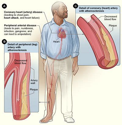 Atherosclerosis - Physiopedia