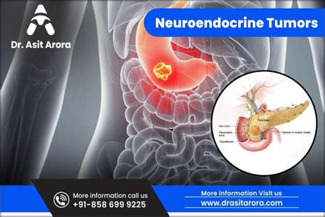 Neuroendocrine Tumors: Symptoms, Causes, and Treatment Options Explained