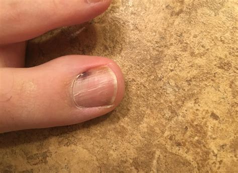 Melanoma under toenail pictures: black spot, nail melanoma pictures ...