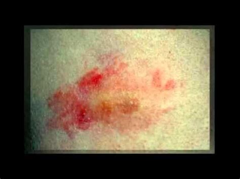 Stages Of Shingles Rash - YouTube