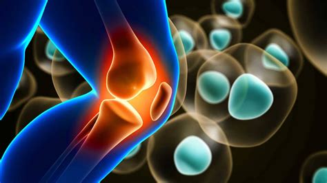 Stem Cell Therapy vs. Joint Replacement for Knee Pain - Stemcell Miami