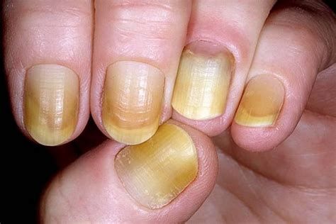 Yellow Nail Syndrome: Causes, Symptoms and Treatment