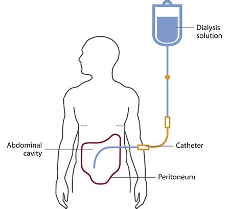 Peritoneal Dialysis | NIDDK