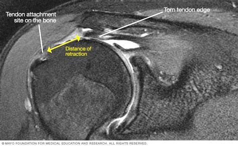 MRI of torn rotator cuff | Rotator cuff, Mri, Rotator cuff rehab