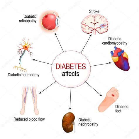 Diabetes Mellitus