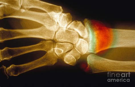 Colles Fracture, X-ray #1 Photograph by Scott Camazine - Pixels