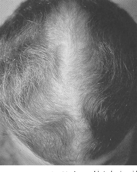 Figure 1 from Hair Disorders: Patient Presentation in the Practical ...