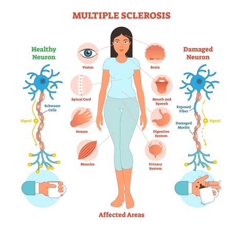 Multiple Sclerosis | Sclerosis Specialist in Faridabad | Dr Rohit Gupta