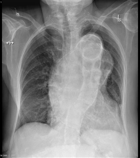 Pin on Chest Radiology