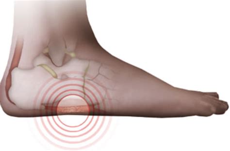 Why Do I Suffer From Lateral Foot Pain? - Foot & Ankle Center of Arizona