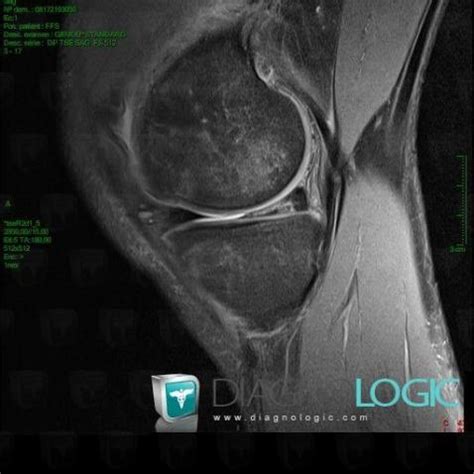 Radiology case : Degenerative joint disease (MRI) - Diagnologic