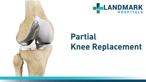 Partial Knee Replacement in Hyderabad By Dr. Sudhir Kumar Reddy ...