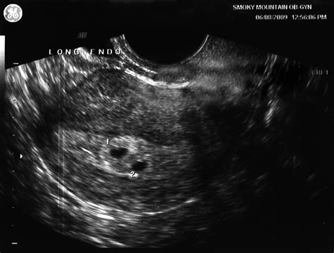 Pregnancy Ultrasound Pictures At 3 Weeks