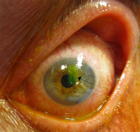 Recurrent Corneal Erosion (RCE) | Canadian Association of Optometrists