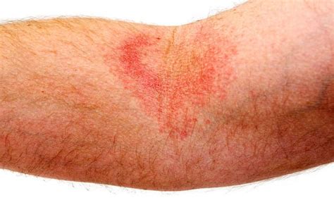 Eczema: Eight tips to help ease inflammation and discomfort caused by ...