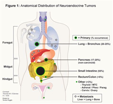 Neuroendocrine Tumour: Know about the disease, its types and survival ...