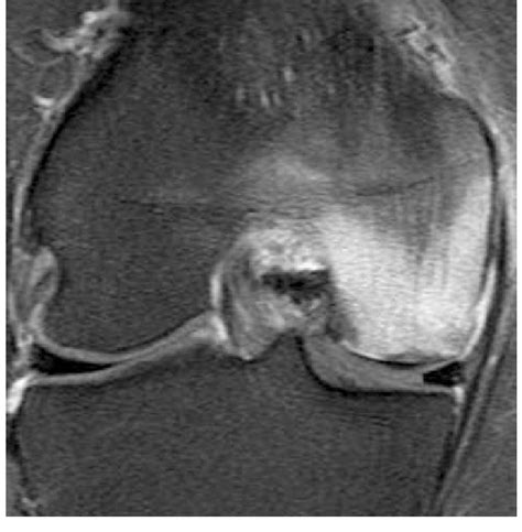 Bone marrow edema pattern (BME) on MRI (low-signal changes on ...