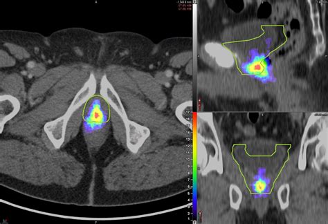 PSMA PET scanning can improve decision making for prostate cancer treatment