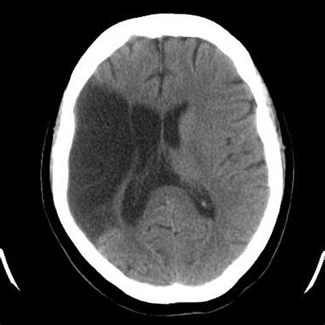 Stroke Ct Scan