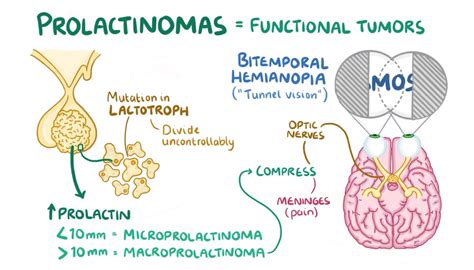 Prolactinoma Flashcards | Memorang