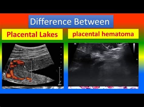 Distinction between Placental Lakes and placental hematoma - YouTube