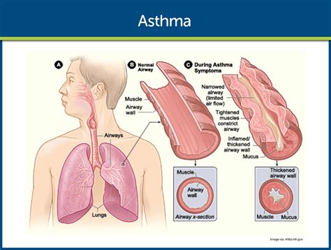 Asthma Nursing Care Management and Study Guide