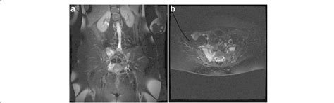 MRI of pelvis. a coronal T2 demonstrating bone marrow edema with ...