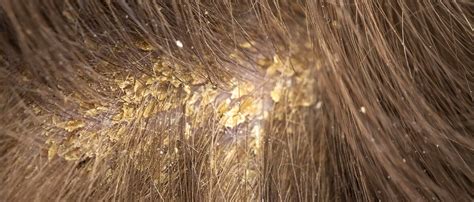 Best Home Remes For Scalp Ringworm - Homemade Ftempo