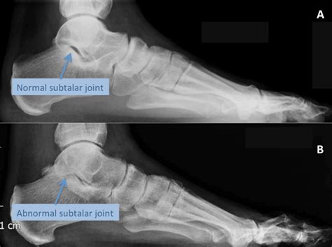 Subtalar Joint - Podiatry, Orthopedics, & Physical Therapy