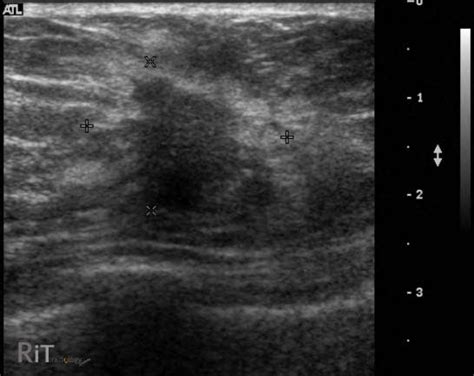 RiT radiology: Ultrasound Features of Malignant Breast Mass