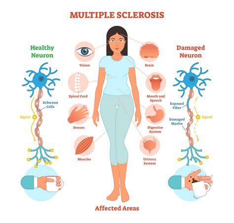 What causes multiple sclerosis? What we know, don't know and suspect