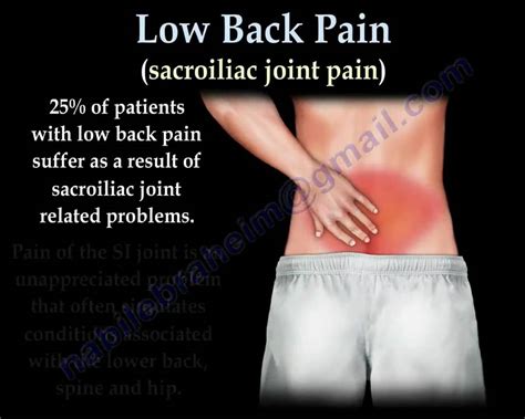 Sacroiliac Joint pain ,causes, treatment - Everything You Need To Know ...