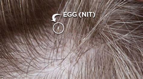 What are Nits & What do They Look Like | The Lice Removal Clinic