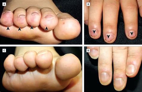 Splinter hemorrhages causes, what it looks like, diagnosis & treatment