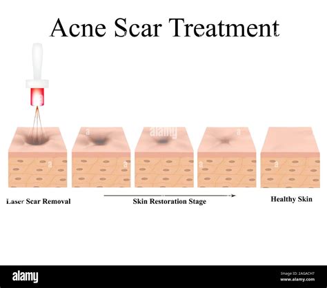 Acne scars. Laser scar atrophic treatment. The anatomical structure of ...