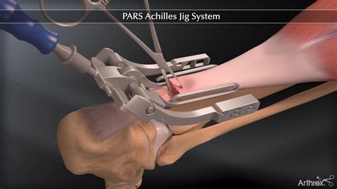 Arthrex - PARS Achilles Jig System