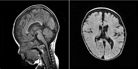 A brain MRI (at 11 months of age) shows diffuse atrophy in both ...