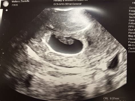 Baby at 7 weeks ultrasound twins Idea | hostalelportalico