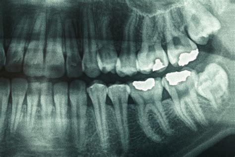 Why Do My Teeth Need an X-Ray? | Tooth X-Ray