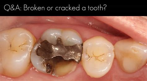 Broken Tooth or Cracked Teeth | Windsor Dentists