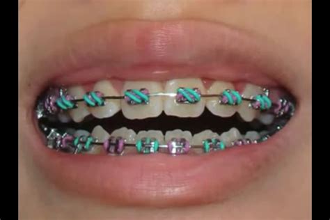 bloggingforfun6395: Different Colored Braces Bands