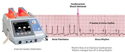 Atrial Fibrillation: My Father Is Always Out of Rhythm! | Patient's Lounge