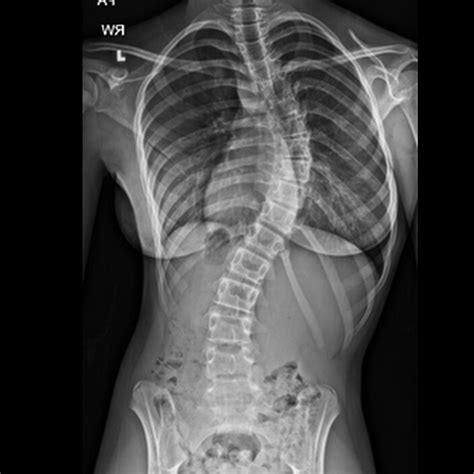 Scoliosis: A Chronic Condition That Can Cause Back And Spine Pain ...