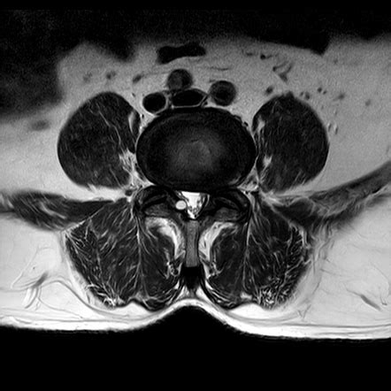 Ligamentum Flavum