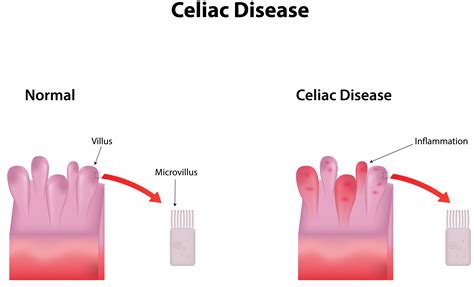 Celiac disease - DaineSalmah