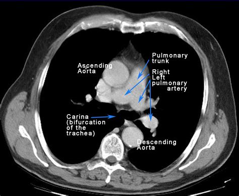 The Anatomy of Clinical Procedures: Lung Cancer (Pneumonectomy)