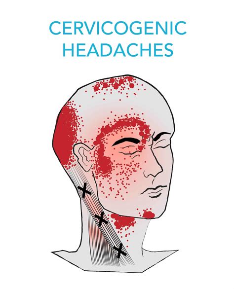 Complete Car Physio - Cervicogenic Headache