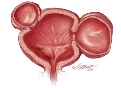 What is a Bladder Diverticulum? - Urology Care Foundation